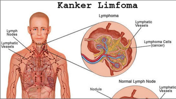 Perbedaan Kanker Limfoma dan TBC: Penjelasan dari Dokter