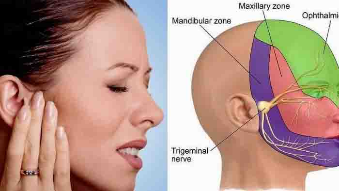 Trigeminal Neuralgia: Ketika Nyeri Mirip Sakit Gigi