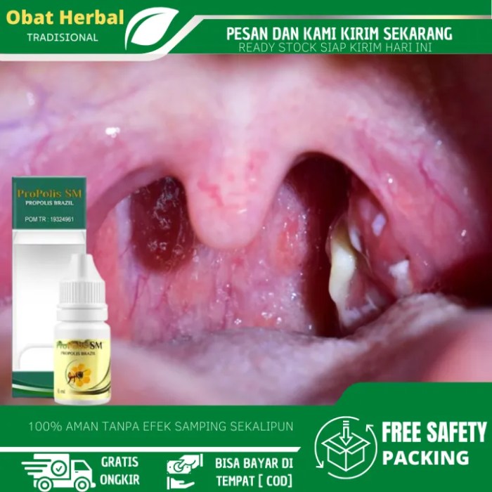 Obat Amandel Alami